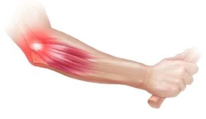 Diagram of tennis elbow inflammation in the forearm